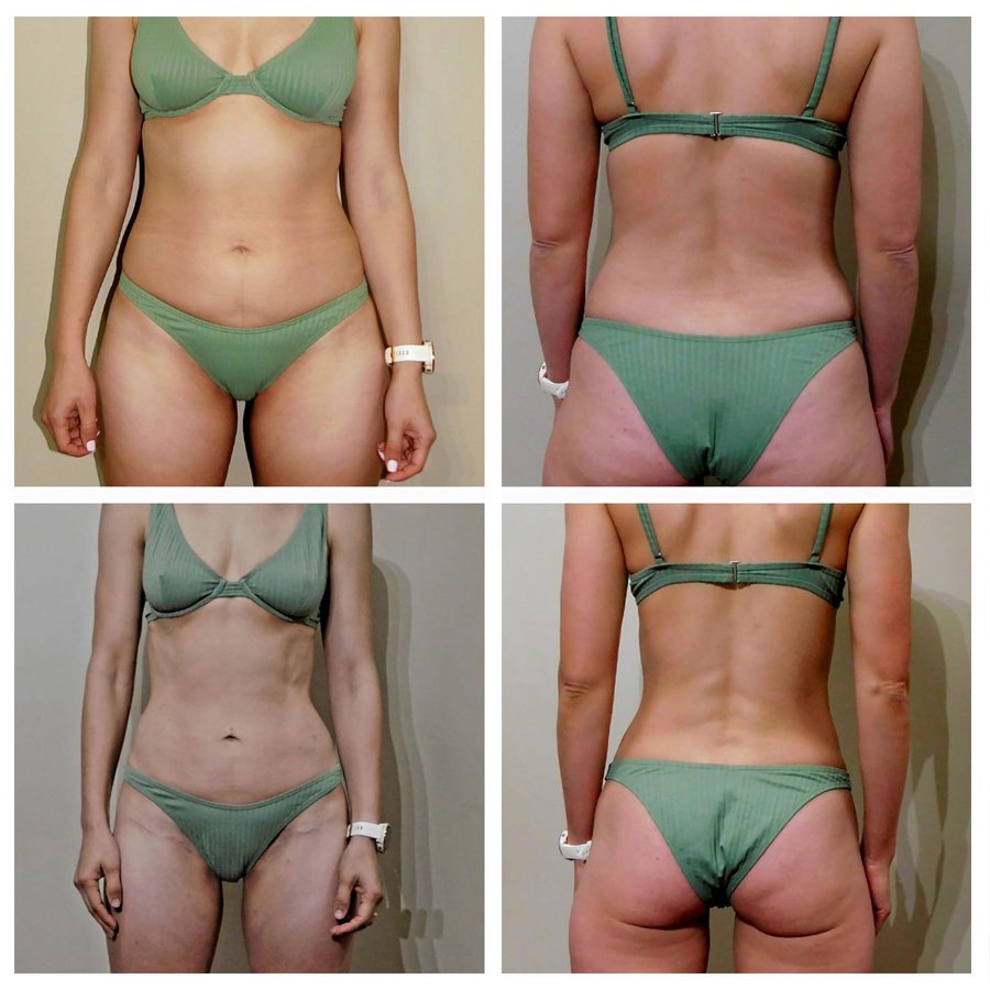 Client 5 — Front & Back Progress